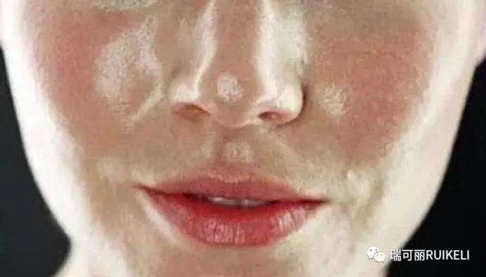 怎样让粗大的毛孔减少,毛孔变黑且粗大怎么治