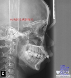 正畸医生如何指定方案的,正畸医生怎么说