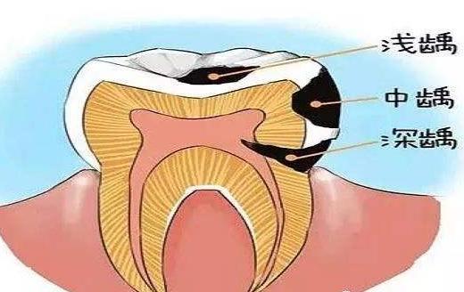 牙齿凌晨4.5点痛白天就不痛,牙齿白天不疼晚上疼是牙坏了吗