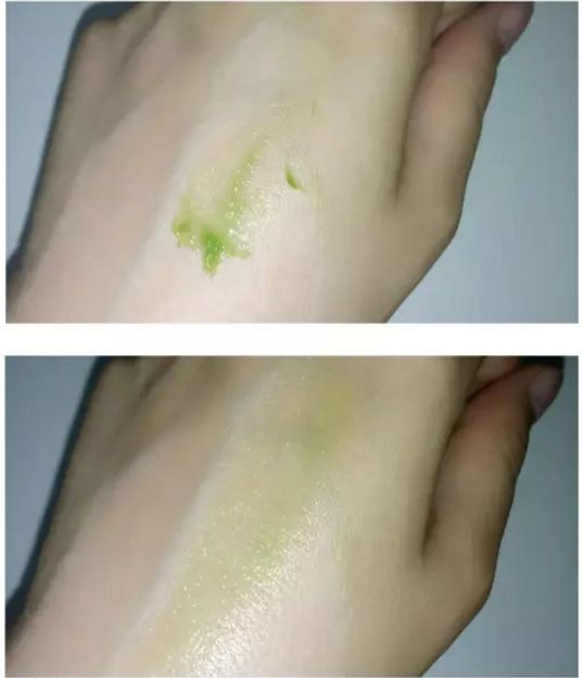 蚊虫叮咬后能用烫伤膏吗,烫伤烧伤瘙痒蚊虫叮咬用什么药膏