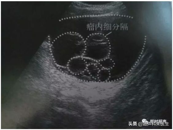 妇科常见疾病的超声诊断视频,超声常见疾病