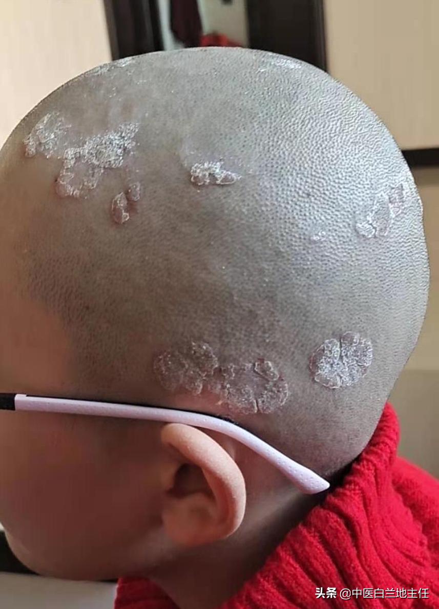 「病例分享」5岁小男孩头部银屑病终好转