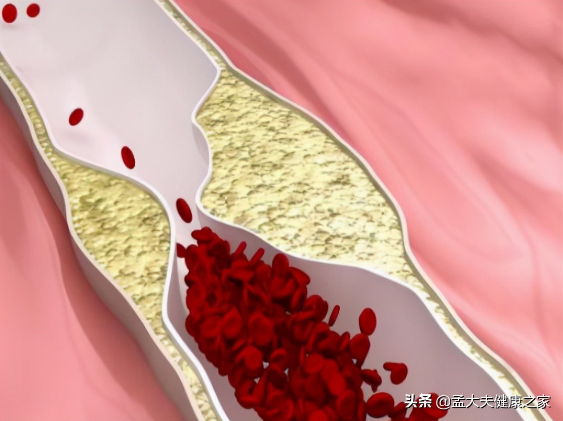 最适合老年人的沙坦类药,最适合老年人服用的降压药是