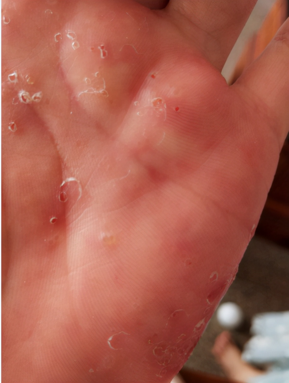 手足癣反反复复的原因,手足癣反反复复有办法治疗吗