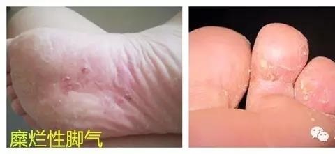 你有脚气吗健康养生,专家课堂讲治脚气