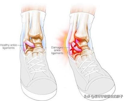 您重视过踝关节扭伤吗?扭伤3个月还不好,我们应该做点什么呢?