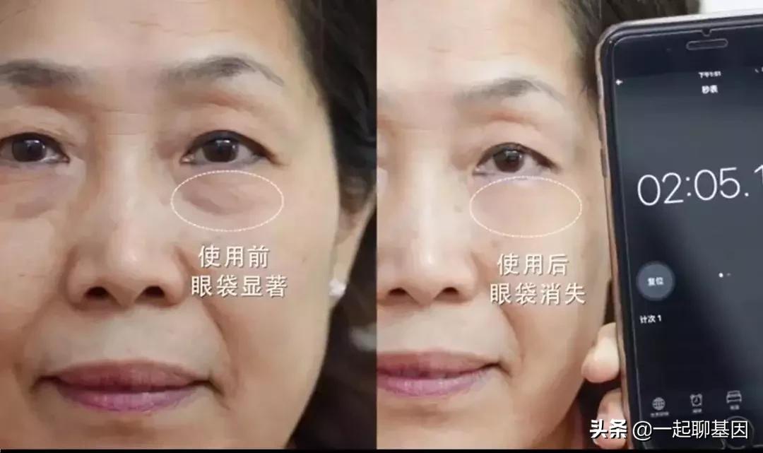 大眼袋眼纹抹平了,眼纹医美怎么去除