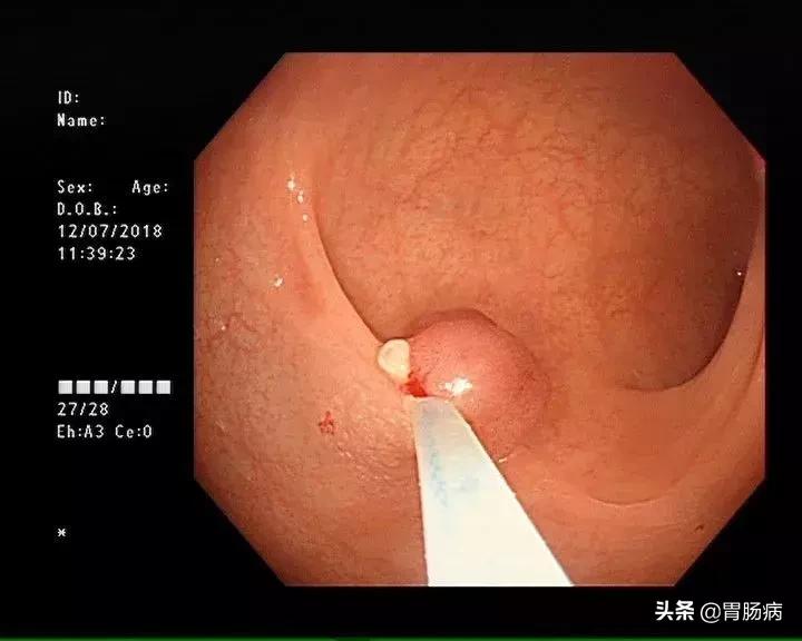 大肠息肉—藏在肚子里的定时*弹炸**，只要发现，必须格杀勿论！