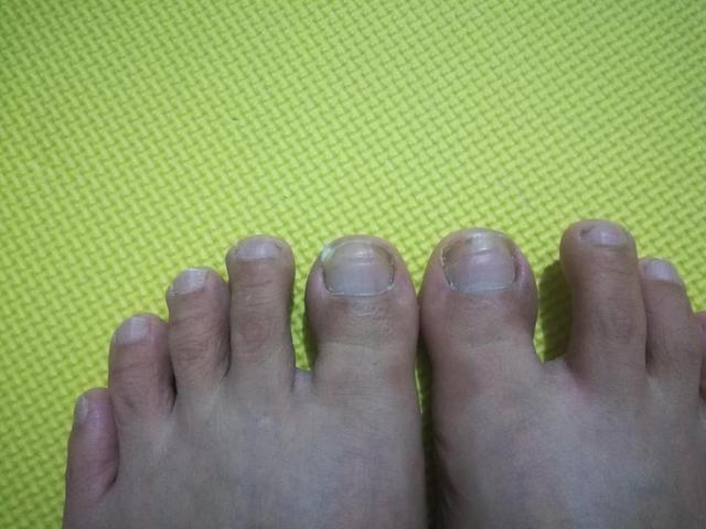 甲沟炎自愈的经历,甲沟炎的亲身经历