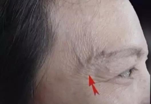 头部血管突出青筋暴起是什么原因,头部青筋