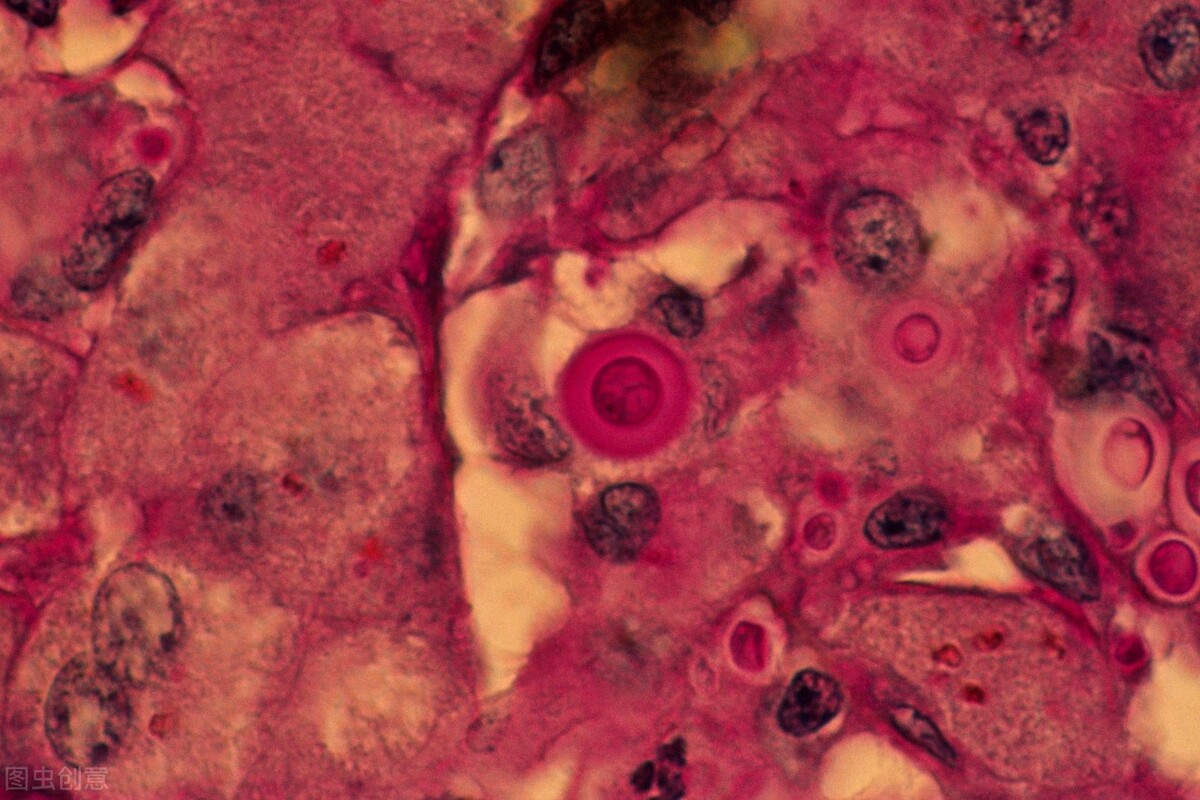 这种病菌1亿年前就有了，后来地球出现人类，它又学会了感染人肺