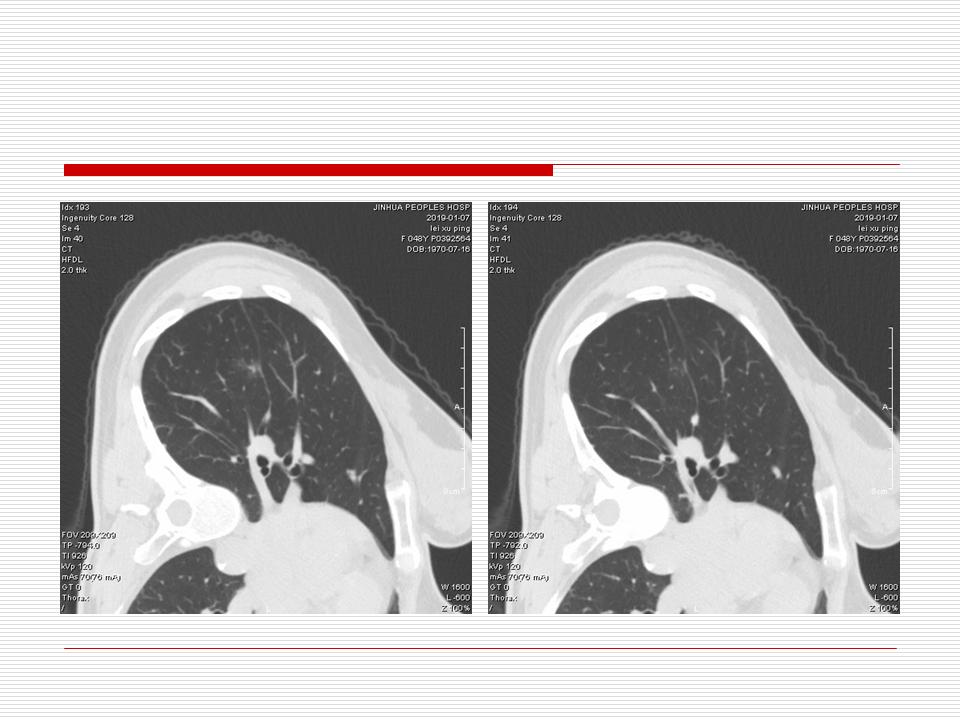 像炎症的肺癌能治好吗,医生说可能是肺癌也可能是炎症
