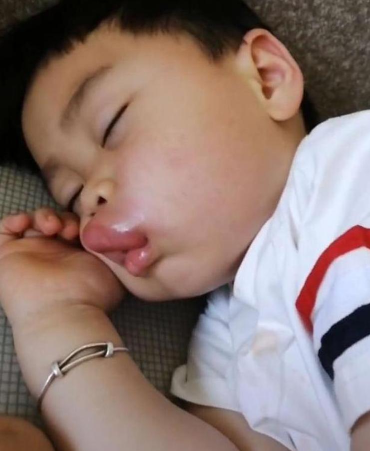 小孩嘴巴肿了一块,小孩嘴巴突然肿了