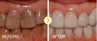 四环素牙治疗方法哪种效果好,四环素牙是树脂好还是陶瓷好