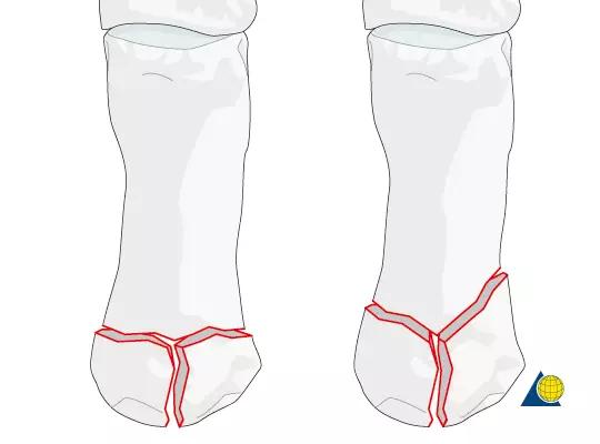 特殊骨折类型,特殊骨折体征