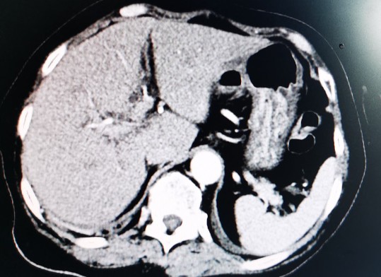 黄婶的肝癌用介入治疗已经3年多了-适合自己的治疗才是最好的治疗