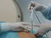 外科微创心脏房颤消融流程,心血管房颤治疗