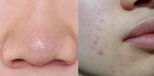 吸黑头神器去粉刺角质收缩毛孔,皮肤清洁收缩毛孔黑头角质