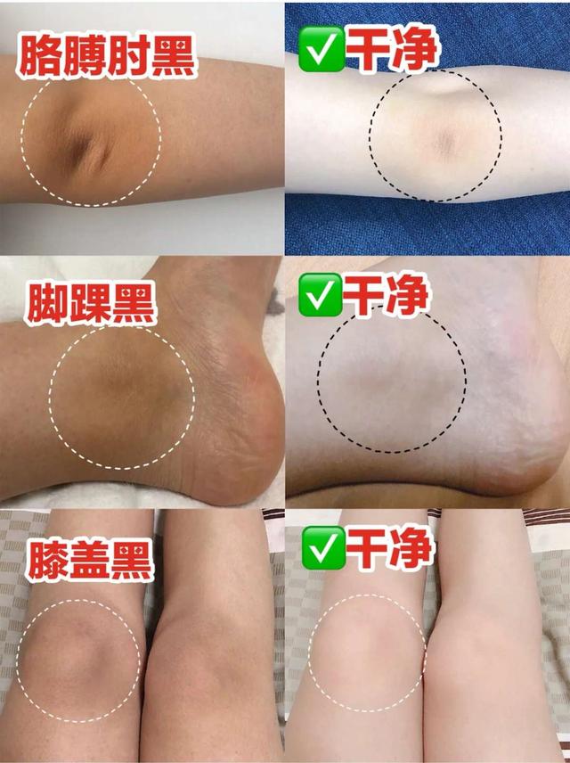 洗澡时搓出来的泥是怎么回事,为什么洗澡搓泥是白泥