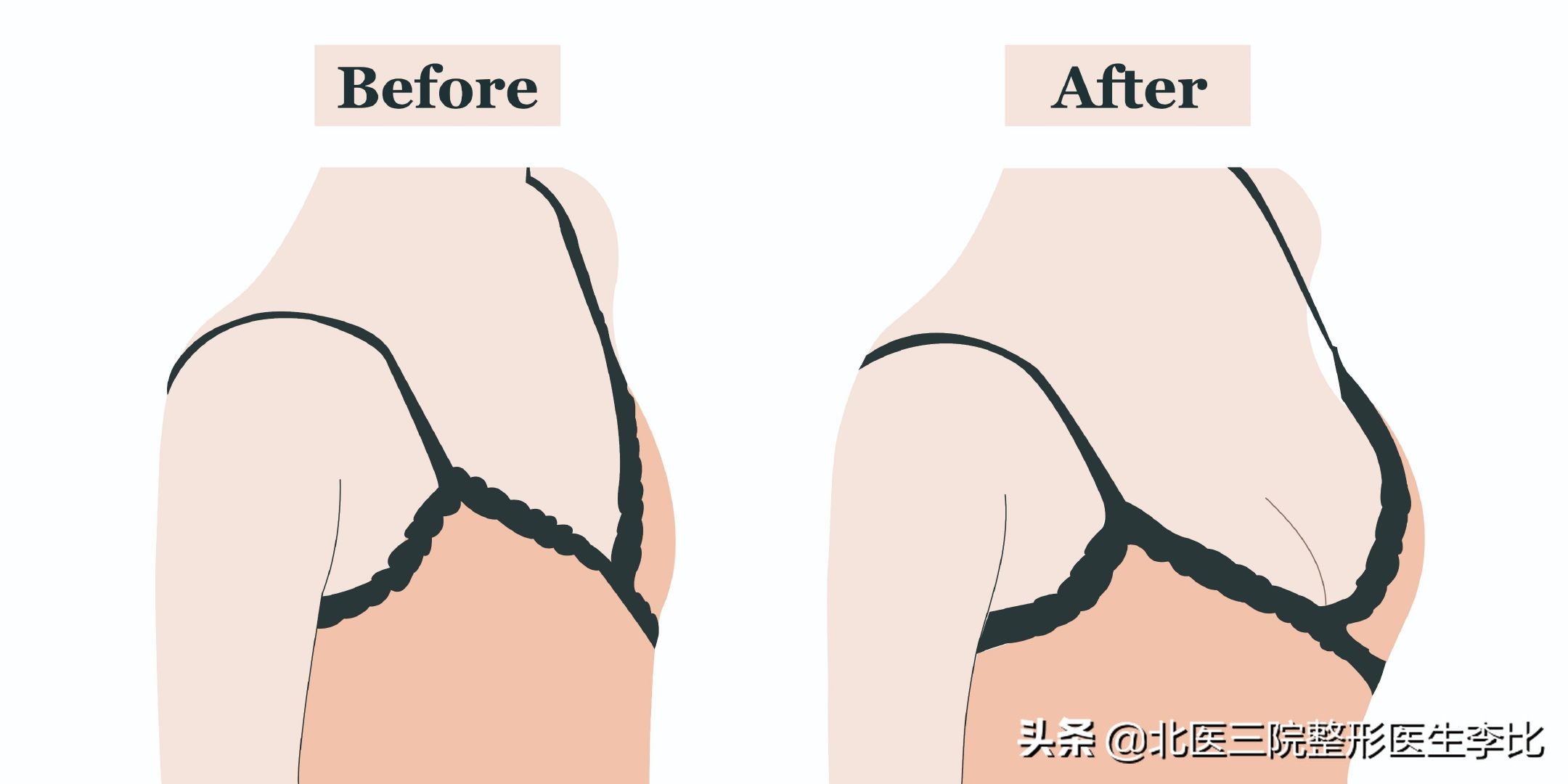 丰胸方法千万种到底哪种才靠谱,目前丰胸最靠谱的方法