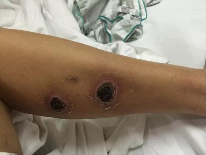 老烟民请注意,老烟民血管收缩