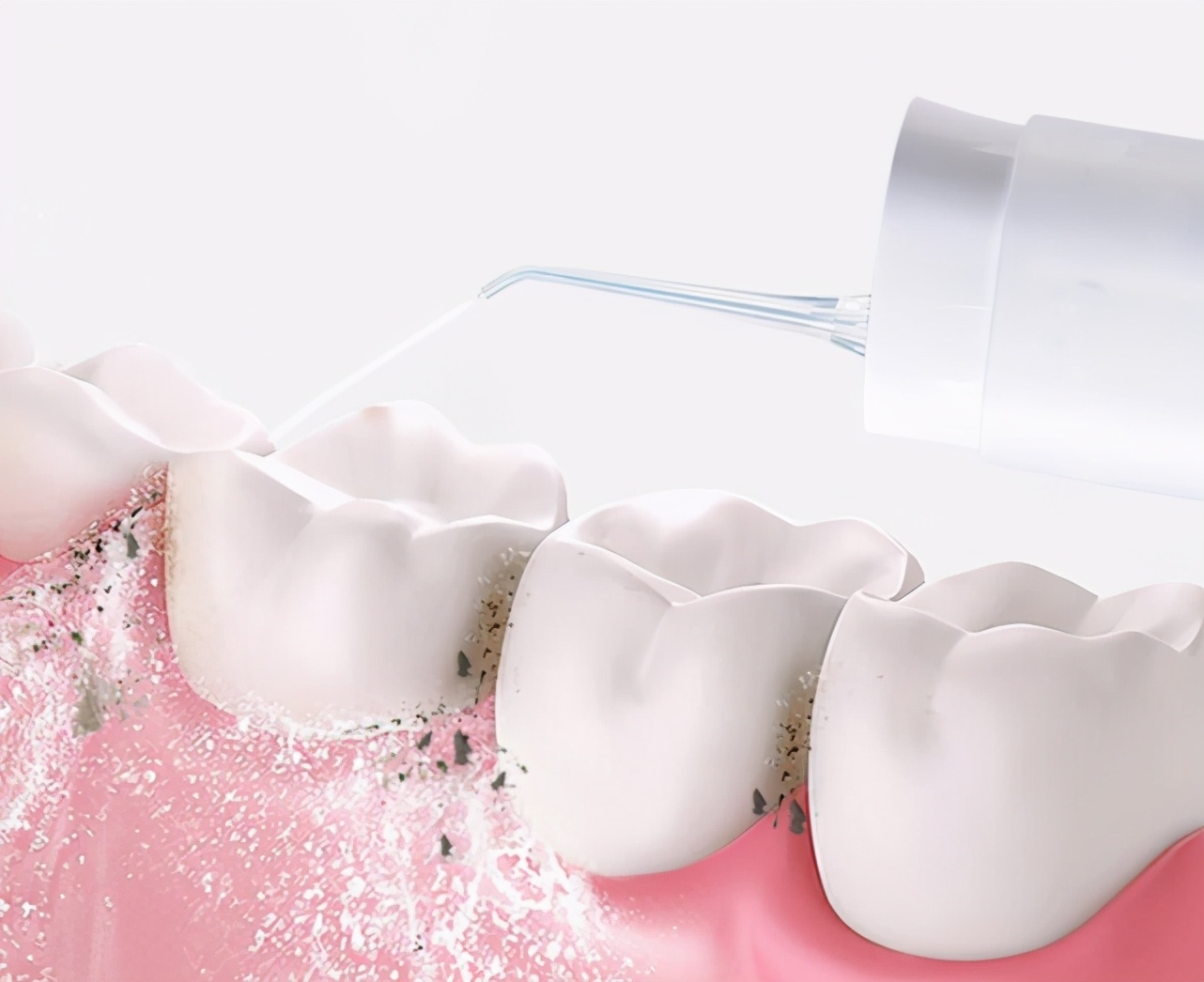 牙龈萎缩牙缝大怎么修补牙缝,牙缝怎么处理不塞东西