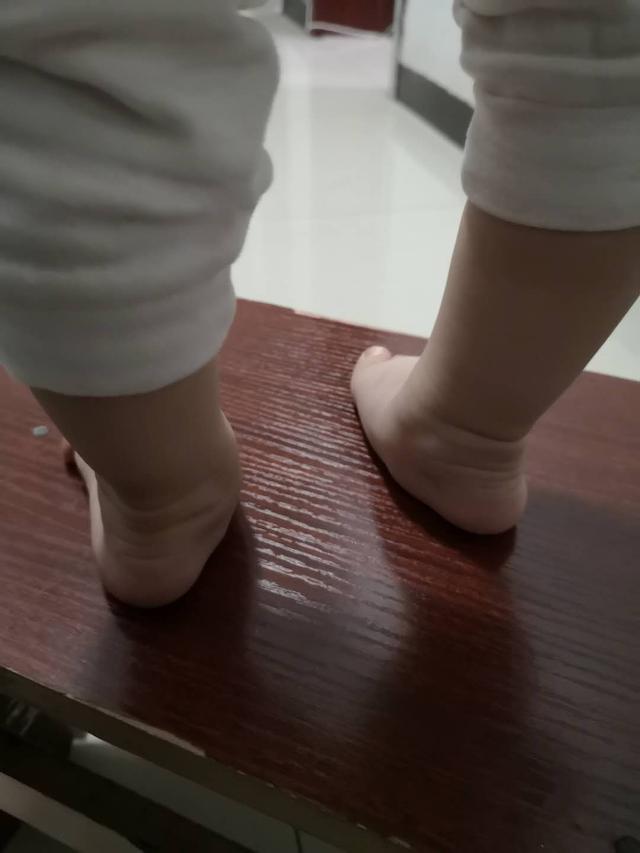 什么是足外翻？需要治疗吗？