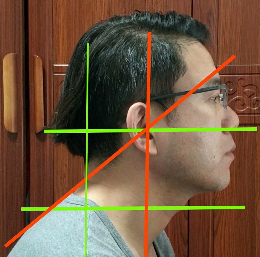 脖子后面颈椎有个鼓包怎么办,颈椎大包怎样通过锻炼来恢复