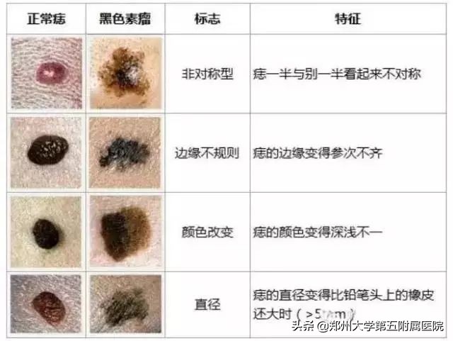 色素痣病理报告,头上色素痣图片