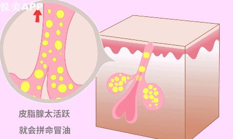 光子嫩肤可以改善毛孔粗大出油吗,怎样改善面部出油长痘毛孔粗大