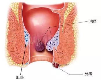 日常简单三步搞定痔疮一身轻,痔疮很小但是没感觉