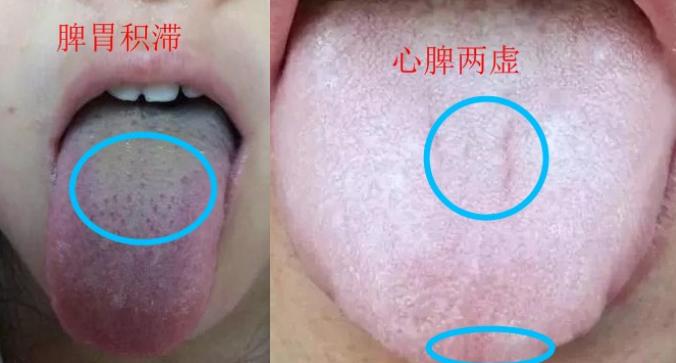 脾虚齿痕舌吃什么中成药,身上没劲乏力肚子难受怎么回事