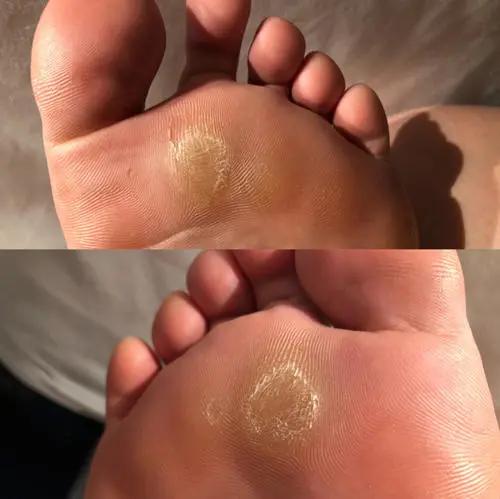 脚上长了茧子怎么回事,如果脚上起硬疙瘩茧子了怎么办