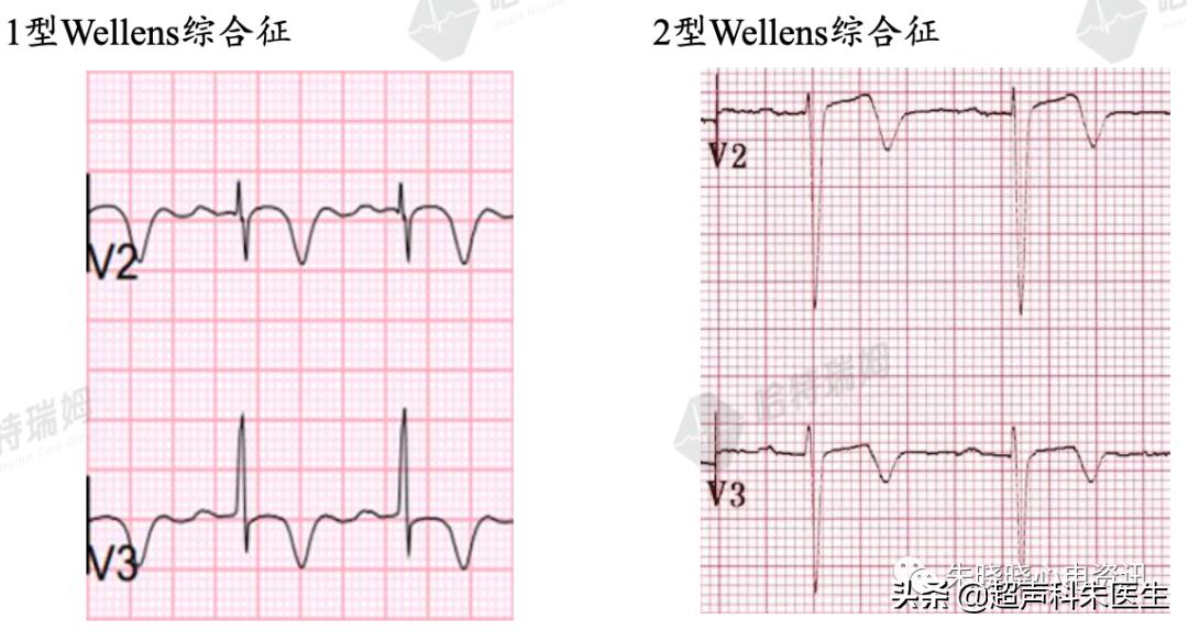 t波倒置9个真相图解,t波倒置判断口诀