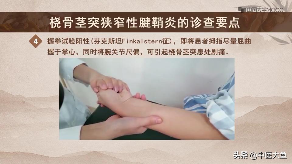 桡骨茎突狭窄性腱鞘炎怎么治疗,桡骨茎突狭窄性腱鞘炎治疗方法