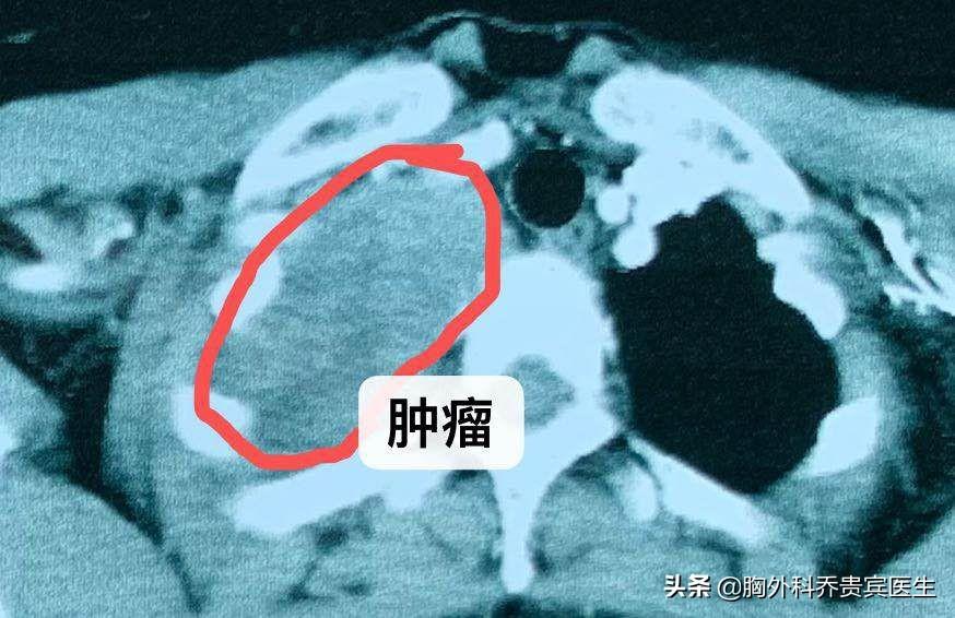 年轻妈妈孕期右手臂疼痛，原来右颈胸长了巨大肿瘤
