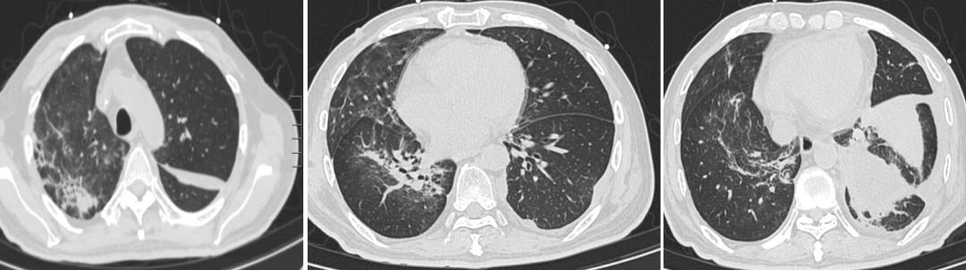 间质性肺病治疗后会加重吗,化疗后肺部间质性的病变