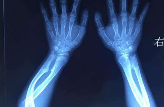 孩子腿上长了个软骨瘤该怎么办,儿童腿部内生软骨瘤耽误生长么