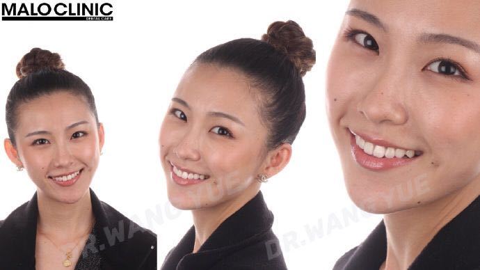 牙齿美学修复的缺点,大龄牙齿矫正经历和感受