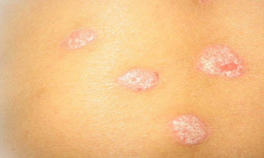 【疾病认知】中医银屑病-白疕