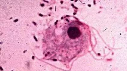 女性阴道炎怎么办?做好这些事,远离难“炎”之隐