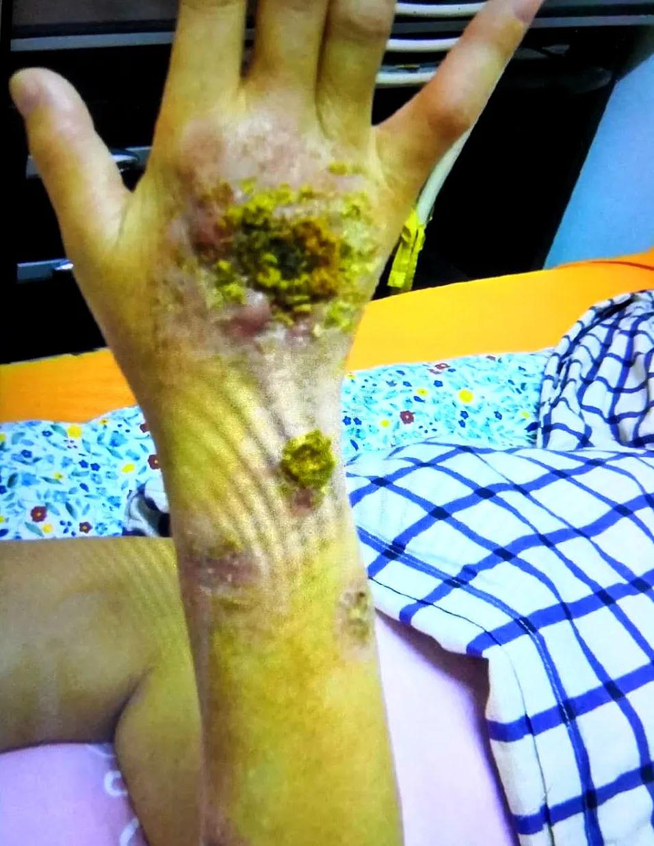 被螃蟹夹一下结果直接进了医院,被螃蟹夹进医院