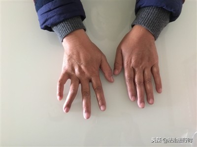 女子车祸1个月后流产索赔6万获2千,车祸锁骨中段骨折如何理赔