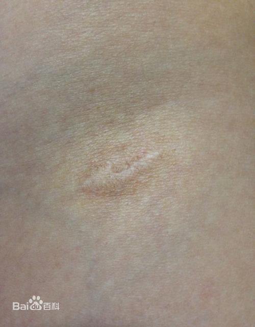 除了肺结核其他结核传不传染,颈部结核病会传染吗