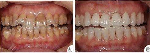 什么是美牙冠矫正,美牙冠对于龅牙效果好么