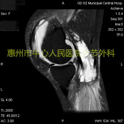 “关节炎”骨科科普逐个说之“化脓性关节炎”