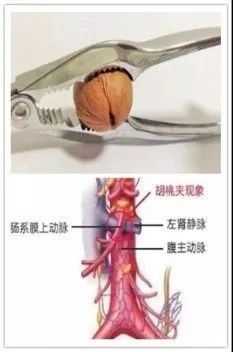 出现血尿一定是膀胱癌吗,出现血尿一定是肾炎吗