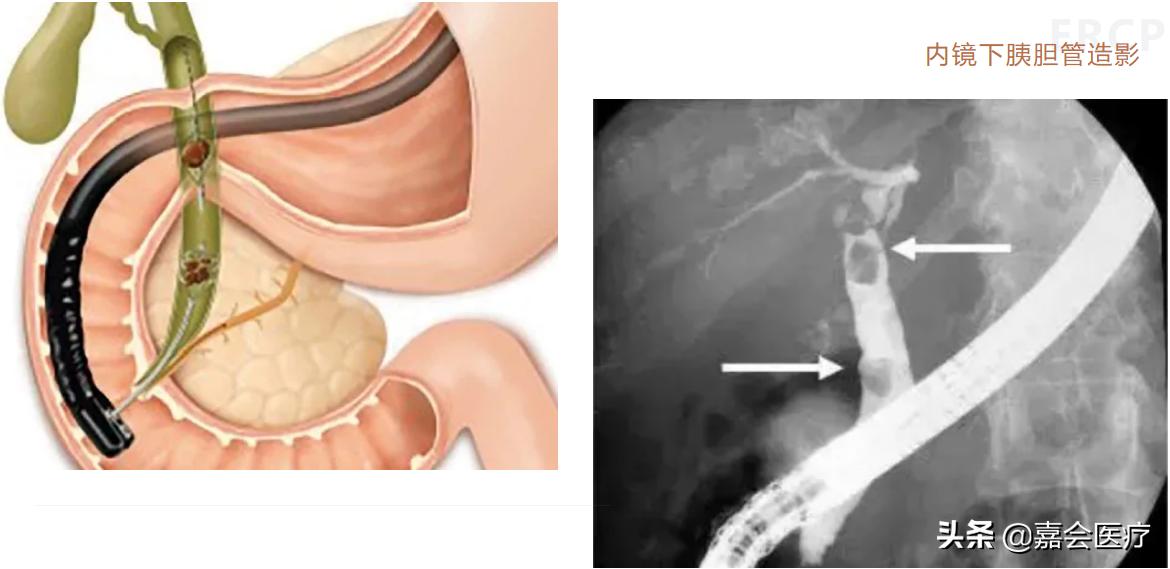 取胆管结石不用开刀，ERCP神奇在哪里？
