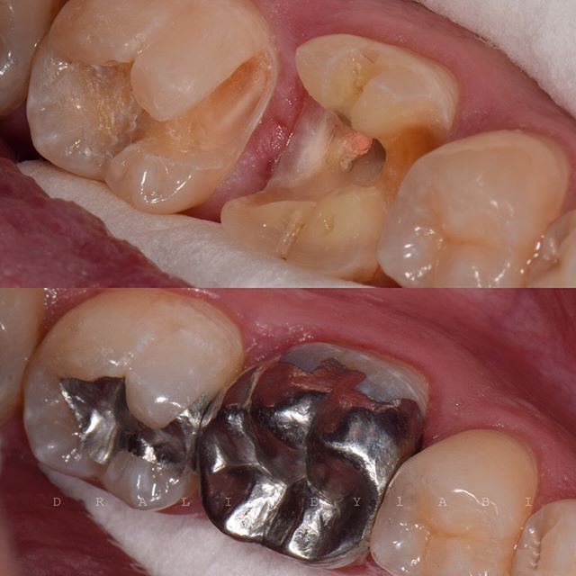 蛀牙补牙的材料基本就这些了,看你要怎么选