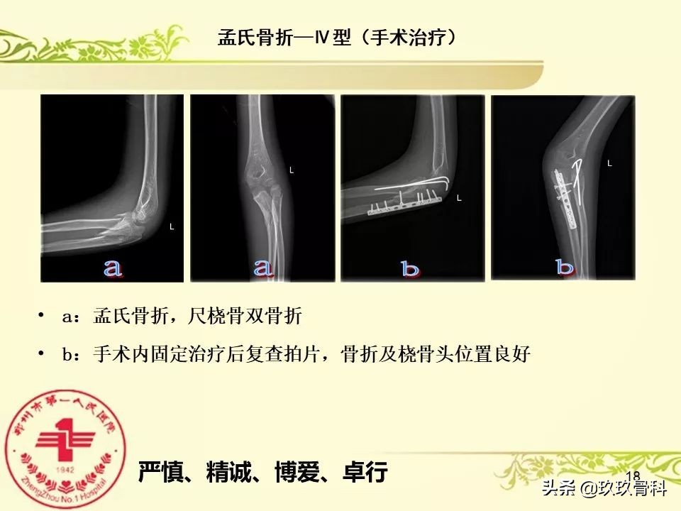孟氏骨折功能训练多久能恢复正常,孟氏骨折中医能治吗